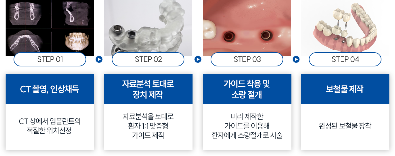 컴퓨터 분석을 이용한 임플란트