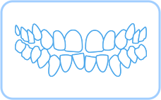 심한 덧니, 뻐드렁니