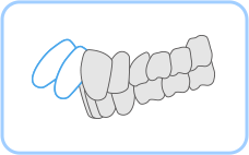 튀어나온 앞니로 인한 돌출입