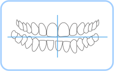 비대칭 부정교합
