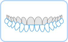 어금니가 거꾸로 물리는 경우