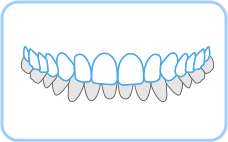 덧니가 아랫니를 크게 덮는 경우