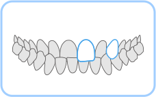치아가 엇갈리게 물리는 경우