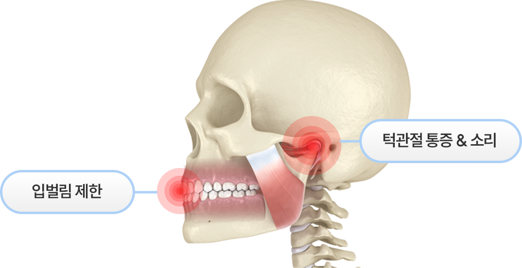 입벌림 제한/턱관절통증&소리