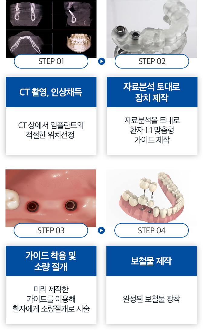 컴퓨터 분석을 이용한 임플란트
