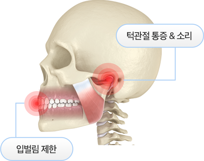 입벌림 제한/턱관절통증&소리